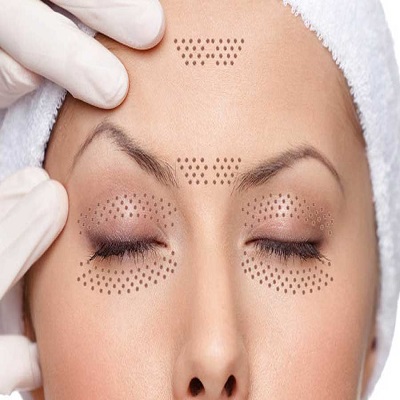 Plexr Plasma Eye Lift in Dubai