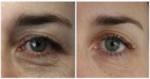 Plexr Plasma Eye Lift before and after