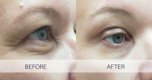 Plexr Plasma Eye Lift before and after