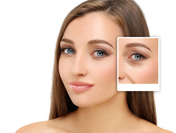 Plexr Plasma Eye Lift in Dubai