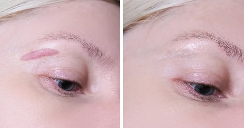 Post-surgical scar treatment before and after