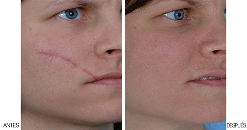 Post-surgical scar treatment before and after