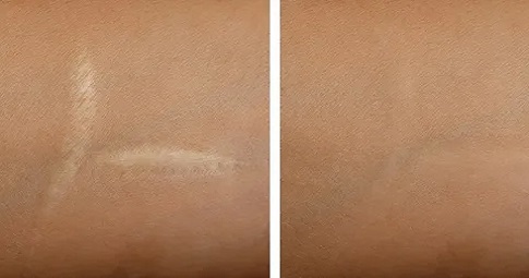 Post-surgical scar treatment before and after
