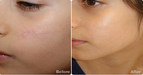 Post-surgical scar treatment before and after
