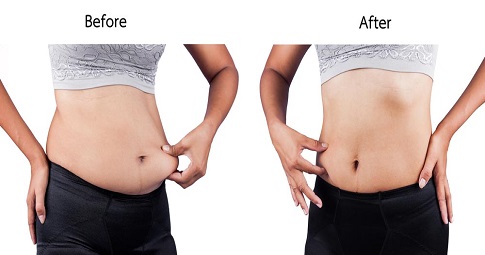 Post-weight loss surgery before and after