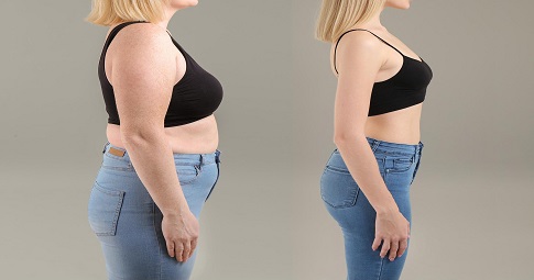Post-weight loss surgery before and after