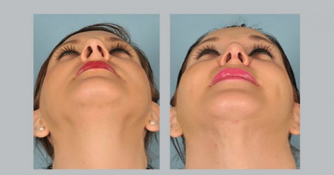 Septoplasty and turbinate reduction before and after