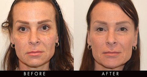 Silhouette Soft Thread Lift before and after