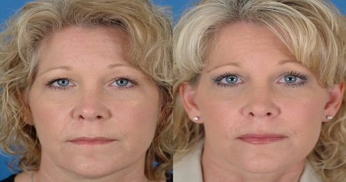 Silhouette Soft Thread Lift before and after