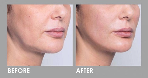 Silhouette Soft Thread Lift before and after