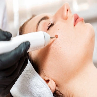 Skin Lesion Removal in Dubai