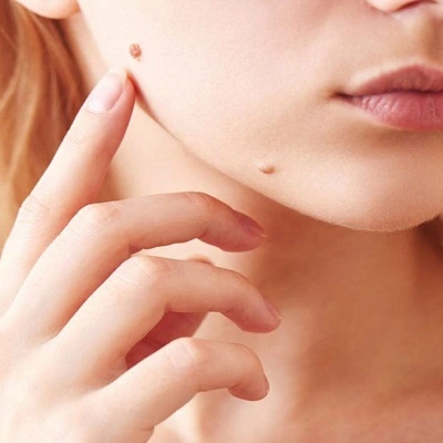 Skin Lesion Removal in Dubai