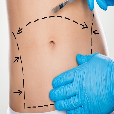 Mini Tummy Tuck in Dubai