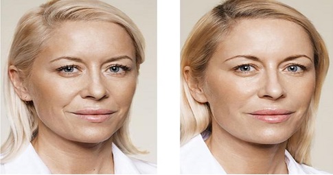 Bio-Revitalization Treatment before and after