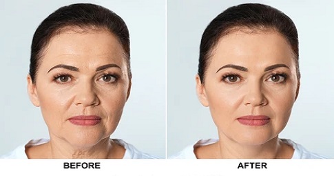 Bio-Revitalization Treatment before and after