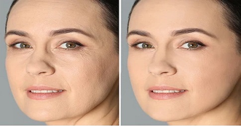 Bio-Revitalization Treatment before and after