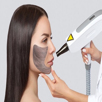 Carbon Laser Peeling in Dubai