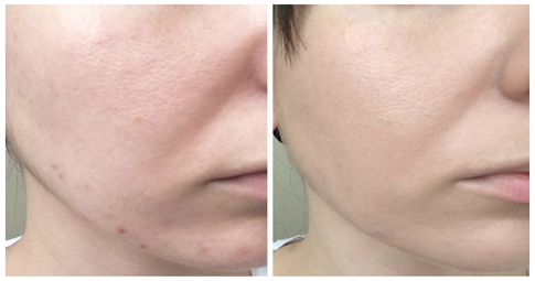 Carbon Laser Peeling before and after