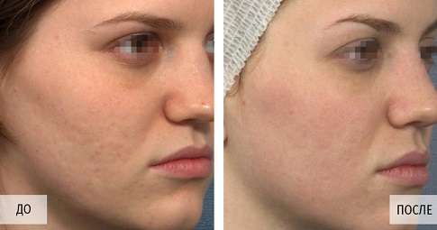 Carbon Laser Peeling before and after
