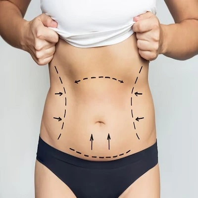 GPS Laser liposuction in Dubai