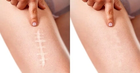 Laser Scar Removal before and after
