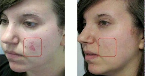 Laser Scar Removal before and after