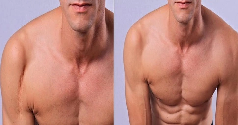 Laser Scar Removal before and after