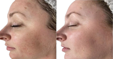Laser Treatment in Dubai