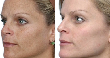 Laser Treatment in Dubai