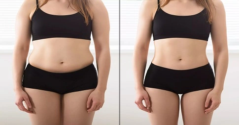 Slimming Treatments before and after