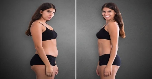 Slimming Treatments before and after