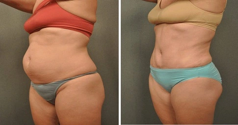 Slimming Treatments before and after