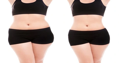 Slimming Treatments before and after