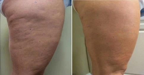 Cellulite Removal Treatments before and after