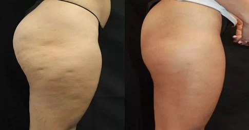 Cellulite Removal Treatments before and after