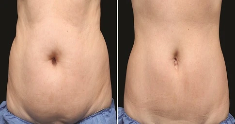 CoolSculpting Fat Freezing before and after