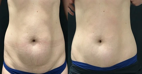 CoolSculpting Fat Freezing before and after