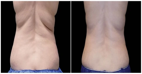 CoolSculpting Fat Freezing before and after