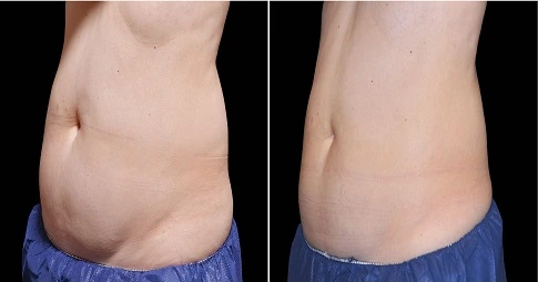 CoolSculpting Fat Freezing before and after