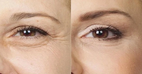 Fine lines and wrinkles before and after