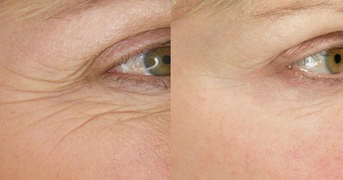 Fine lines and wrinkles before and after