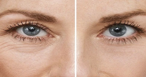 Fine lines and wrinkles before and after
