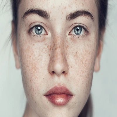 Freckles and blemishes treatment in Dubai
