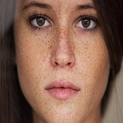 Freckles and blemishes treatment in Dubai