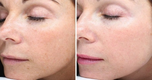 Halo Treatment before and after