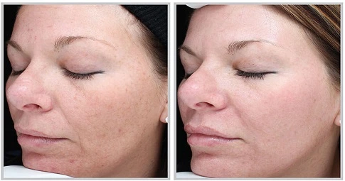 Halo Treatment before and after