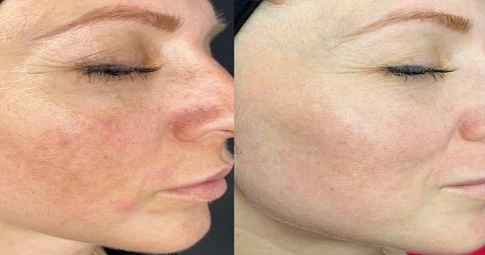 Halo Treatment in Dubai