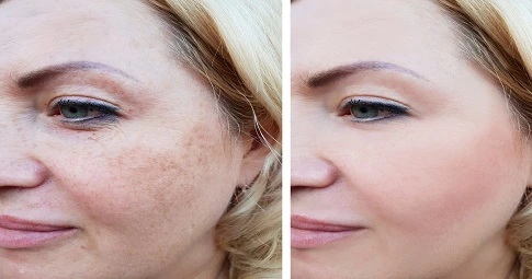 Halo Treatment in Dubai