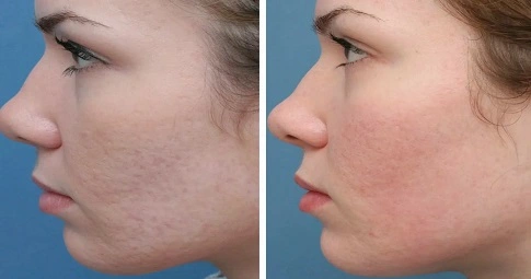 Laser Skin Peeling before and after