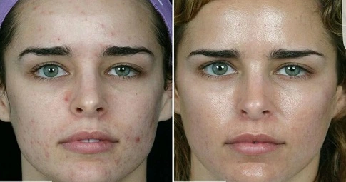 Laser Skin Peeling before and after